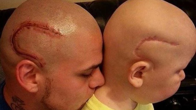 ¡Inspirador! Un padre se tatuó en su cabeza la misma cicatriz tras el cáncer de su hijo para darle autoconfianza 