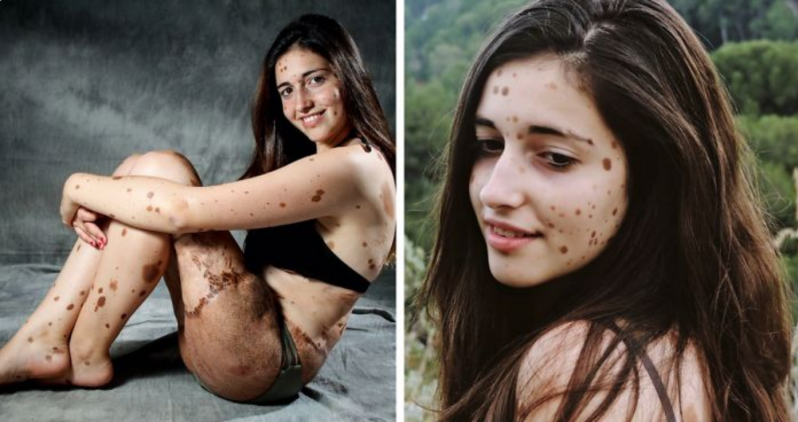 Esta adolescente española fue brutalmente acosada por tener más de 500 manchas de nacimiento, pero solo hay que verla ahora 