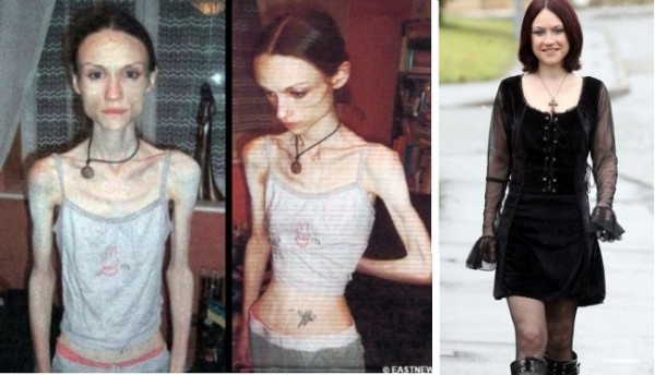 6 mujeres que por increíble que parezca vencieron la Anorexia y ahora viven felices 